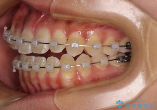 八重歯とオープンバイト 急速拡大装置を用いた矯正治療の治療中