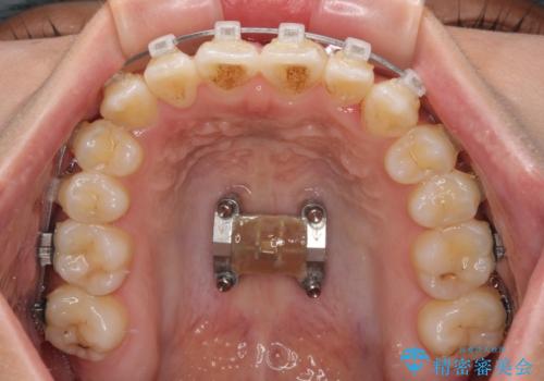八重歯とオープンバイト 急速拡大装置を用いた矯正治療の治療中