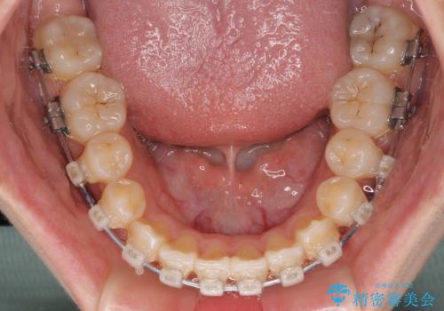 八重歯とオープンバイト 急速拡大装置を用いた矯正治療の治療中