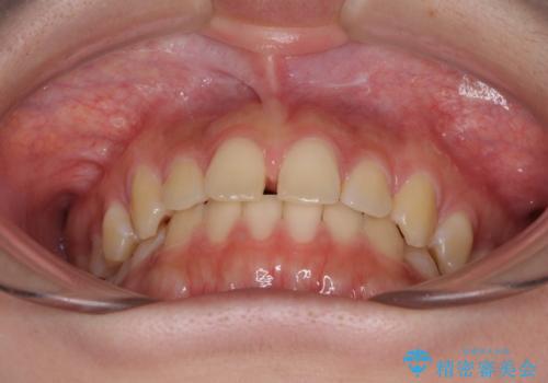 前歯のすきっ歯を治したい　インビザラインによる矯正治療の治療前
