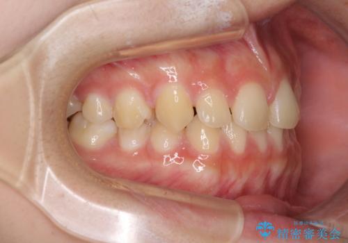 前歯のすきっ歯を治したい　インビザラインによる矯正治療の治療前
