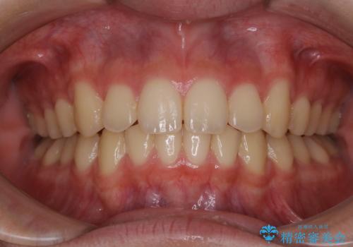 非抜歯で劇的に出っ歯を改善!インビザラインとカリエールの組み合わせ治療の治療後