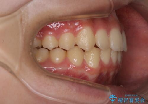 非抜歯で劇的に出っ歯を改善!インビザラインとカリエールの組み合わせ治療の治療後