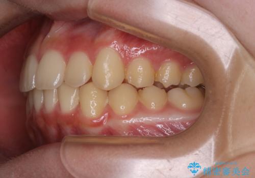 非抜歯で劇的に出っ歯を改善!インビザラインとカリエールの組み合わせ治療の治療後