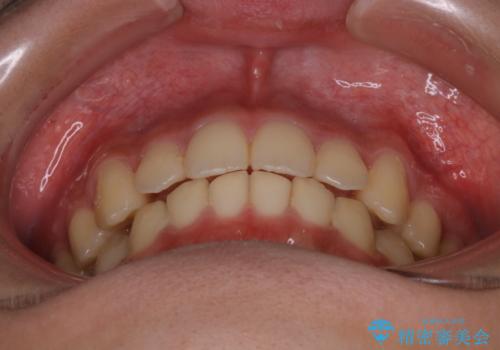 非抜歯で劇的に出っ歯を改善!インビザラインとカリエールの組み合わせ治療の治療後