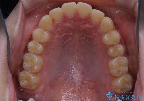 非抜歯で劇的に出っ歯を改善!インビザラインとカリエールの組み合わせ治療の治療後