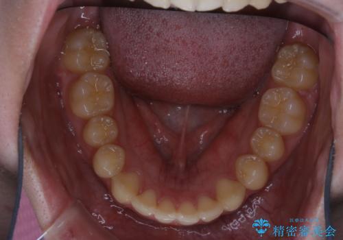 非抜歯で劇的に出っ歯を改善!インビザラインとカリエールの組み合わせ治療の治療後
