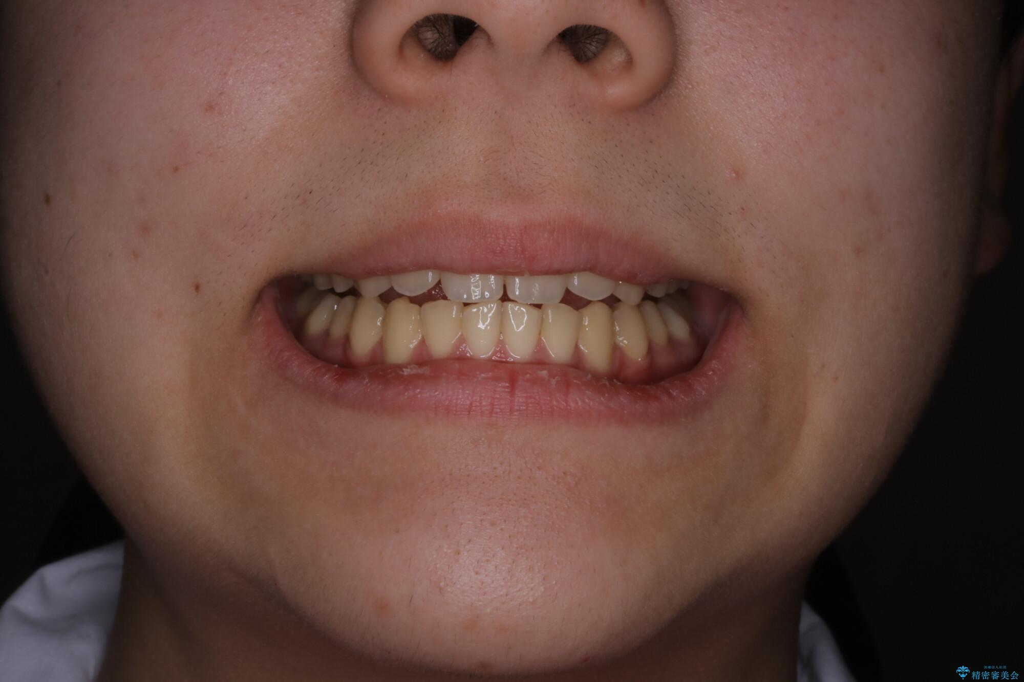 非抜歯で劇的に出っ歯を改善!インビザラインとカリエールの組み合わせ治療の治療後(顔貌)