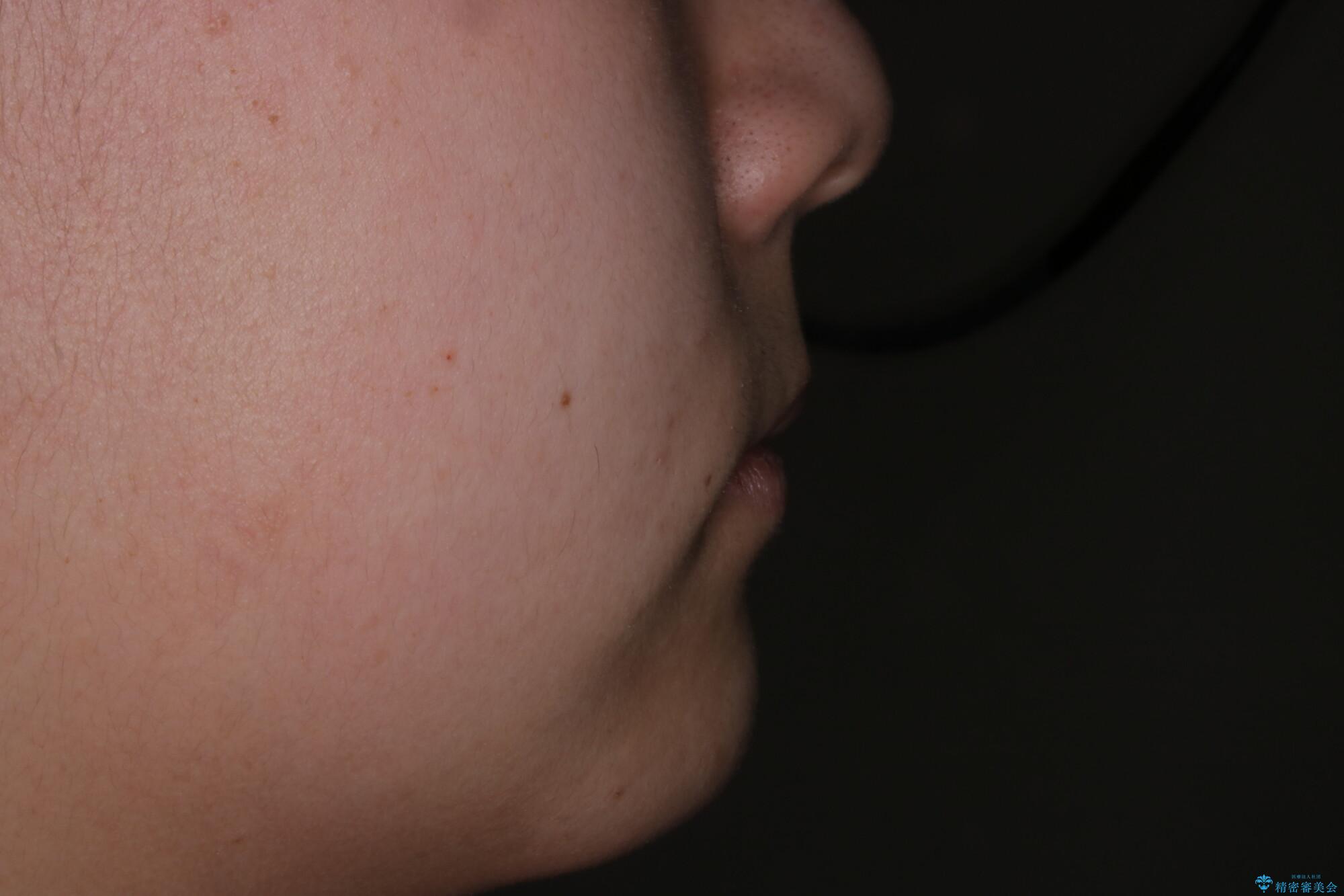 非抜歯で劇的に出っ歯を改善!インビザラインとカリエールの組み合わせ治療の治療後(顔貌)