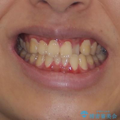 クロスバイトを楽して治す ワイヤー装置にて矯正治療の治療前(顔貌)