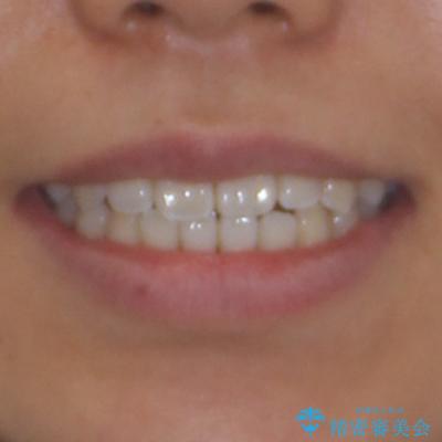 八重歯とオープンバイト 急速拡大装置を用いた矯正治療の治療後(顔貌)
