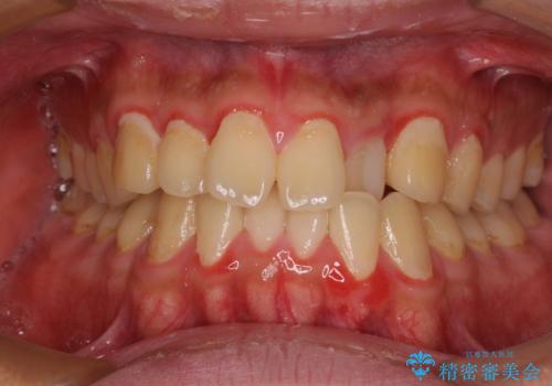 クロスバイトを楽して治す ワイヤー装置にて矯正治療の治療前