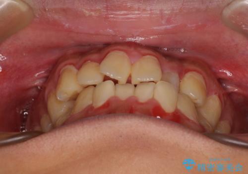 クロスバイトを楽して治す ワイヤー装置にて矯正治療の治療前