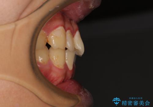 クロスバイトを楽して治す ワイヤー装置にて矯正治療の治療前