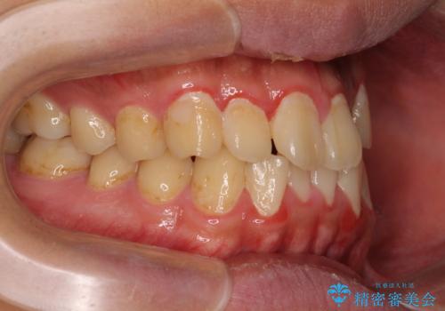 クロスバイトを楽して治す ワイヤー装置にて矯正治療の治療前