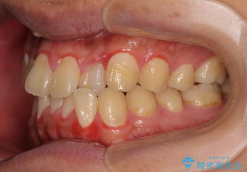 クロスバイトを楽して治す ワイヤー装置にて矯正治療の治療前