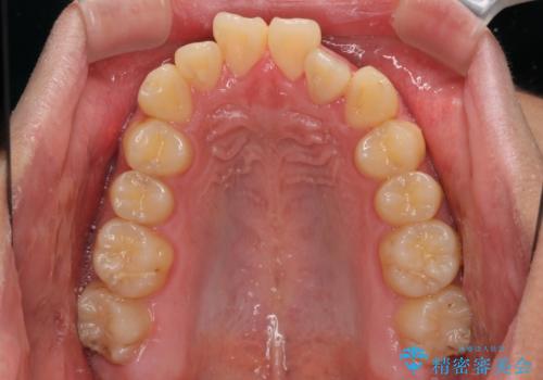 クロスバイトを楽して治す ワイヤー装置にて矯正治療の治療前