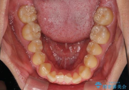 クロスバイトを楽して治す ワイヤー装置にて矯正治療の治療前