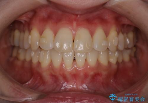 【インビザライン】かみ合わせを整えたいの治療中