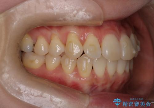 【インビザライン】かみ合わせを整えたいの治療中