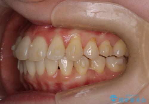 【インビザライン】かみ合わせを整えたいの治療中