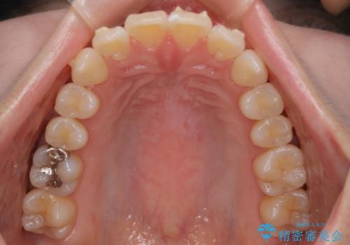 【インビザライン】かみ合わせを整えたいの治療中