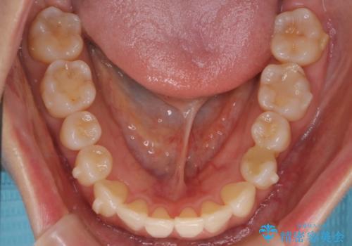 【インビザライン】かみ合わせを整えたいの治療中