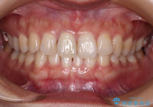 不自然な前歯の被せものをやり替えたいの症例 治療後