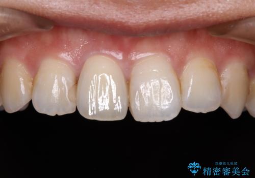 不自然な前歯の被せものをやり替えたいの治療後