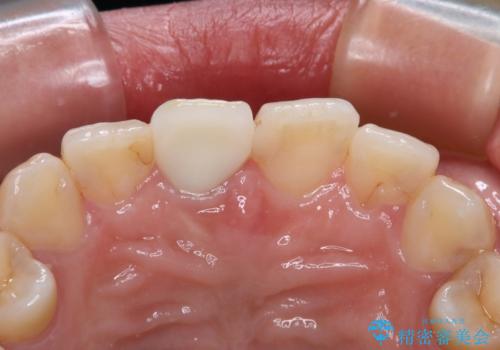 不自然な前歯の被せものをやり替えたいの治療後