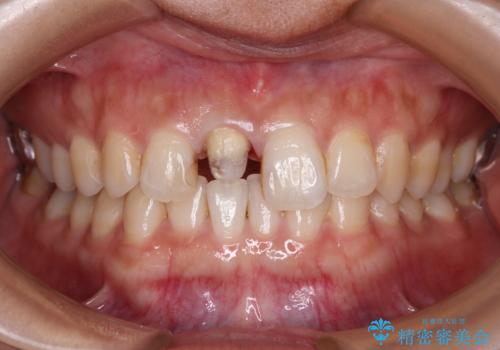 不自然な前歯の被せものをやり替えたいの治療中