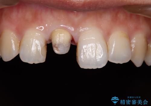 不自然な前歯の被せものをやり替えたいの治療中