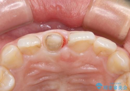 不自然な前歯の被せものをやり替えたいの治療中