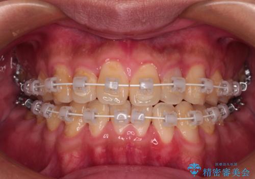 クロスバイトを楽して治す ワイヤー装置にて矯正治療の治療中