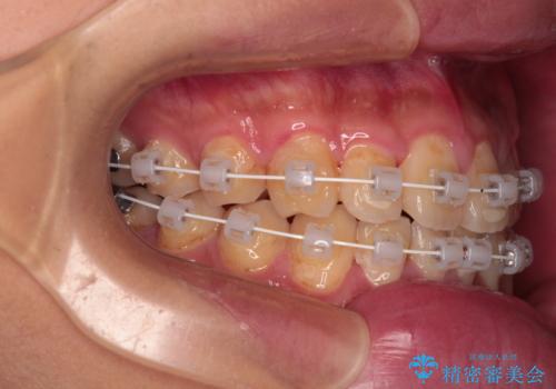 クロスバイトを楽して治す ワイヤー装置にて矯正治療の治療中