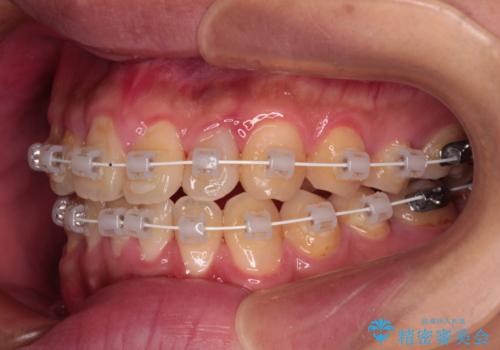 クロスバイトを楽して治す ワイヤー装置にて矯正治療の治療中