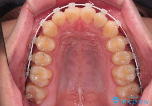 クロスバイトを楽して治す ワイヤー装置にて矯正治療の治療中