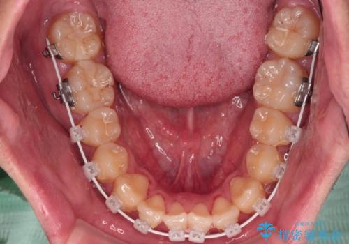 クロスバイトを楽して治す ワイヤー装置にて矯正治療の治療中