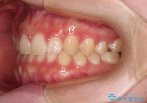 前歯のすきっ歯を治したい　インビザラインによる矯正治療の治療中
