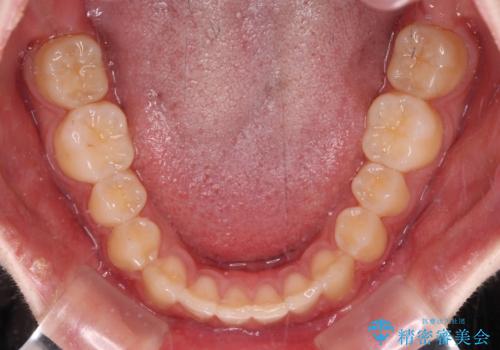 前歯のすきっ歯を治したい　インビザラインによる矯正治療の治療中