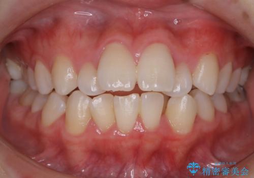 【抜歯】ワイヤー装置で綺麗な歯並び!口元も劇的変化の症例 治療前