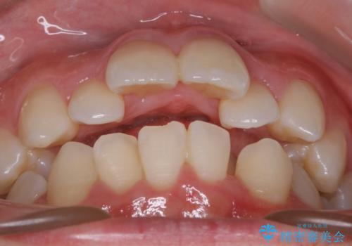 【抜歯】ワイヤー装置で綺麗な歯並び!口元も劇的変化の治療前