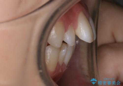 【抜歯】ワイヤー装置で綺麗な歯並び!口元も劇的変化の治療前