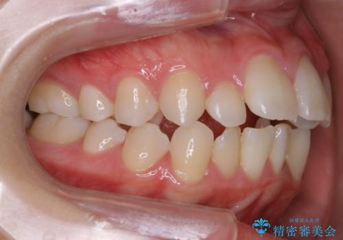 【抜歯】ワイヤー装置で綺麗な歯並び!口元も劇的変化の治療前