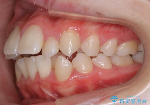 【抜歯】ワイヤー装置で綺麗な歯並び!口元も劇的変化の治療前