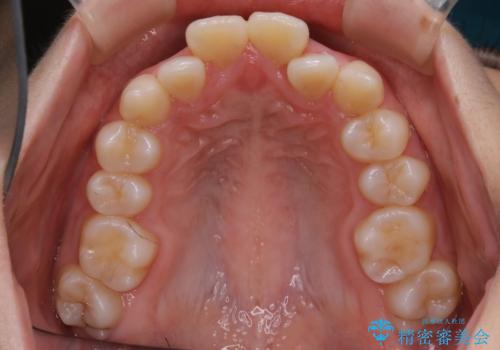 【抜歯】ワイヤー装置で綺麗な歯並び!口元も劇的変化の治療前