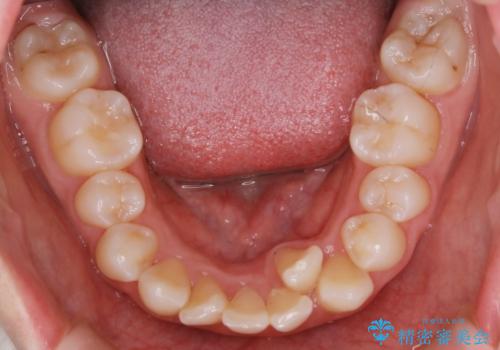 【抜歯】ワイヤー装置で綺麗な歯並び!口元も劇的変化の治療前