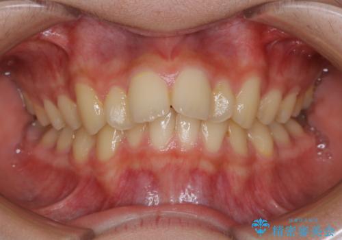 非抜歯で劇的に出っ歯を改善!インビザラインとカリエールの組み合わせ治療の治療前