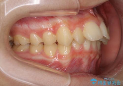 非抜歯で劇的に出っ歯を改善!インビザラインとカリエールの組み合わせ治療の治療前