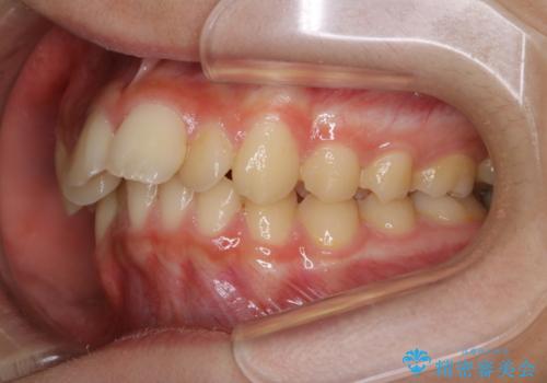 非抜歯で劇的に出っ歯を改善!インビザラインとカリエールの組み合わせ治療の治療前